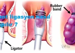 Bant ligasyon nasıl yapılır ?