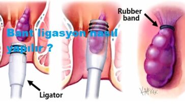 Bant ligasyon nasıl yapılır ?