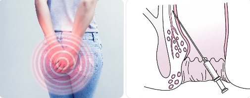 İstanbul Hemoroid Tedavisi (Bağcılar)