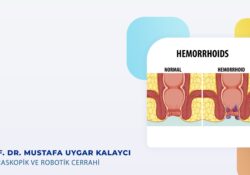 Uzun süre ıkınma hemoroid oluşumunu etkiler mi?