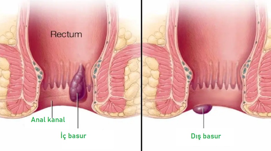 iç basur